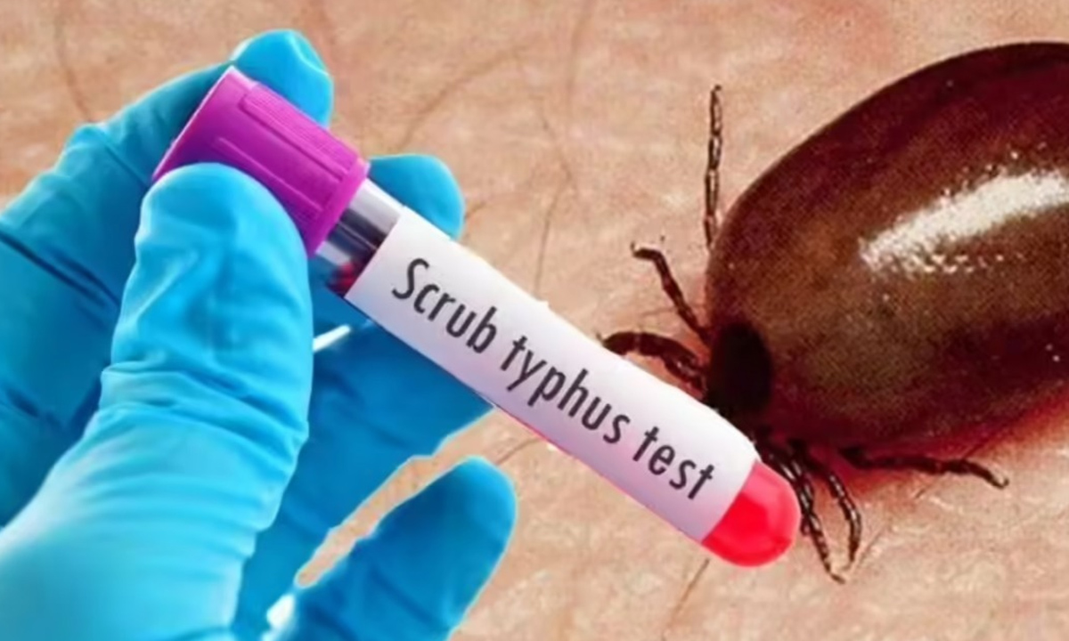 Scrub Typhus